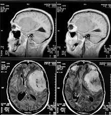 Лечение менингиомы лечение менингиомы