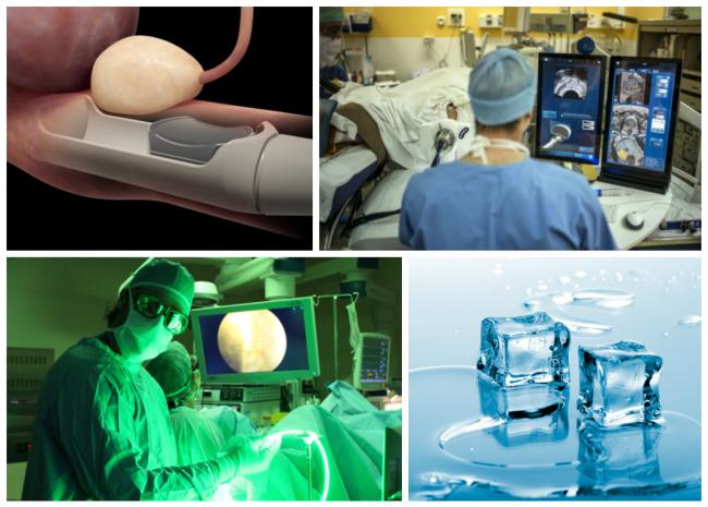 лечение аденомы простаты